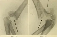 Picture 101 of 481 from Fractures and dislocations, diagnosis and treatment (1915), leaf 155