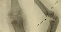 An illustration from Fractures and dislocations, diagnosis and treatment (1915)