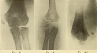 Picture 103 of 481 from Fractures and dislocations, diagnosis and treatment (1915), leaf 157