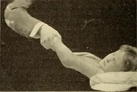 An illustration from Fractures and dislocations, diagnosis and treatment (1915)