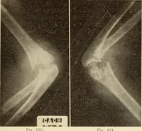 Picture 105 of 481 from Fractures and dislocations, diagnosis and treatment (1915), leaf 164