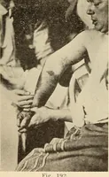Picture 106 of 481 from Fractures and dislocations, diagnosis and treatment (1915), leaf 164