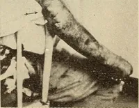 An illustration from Fractures and dislocations, diagnosis and treatment (1915)