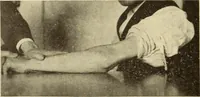 Picture 109 of 481 from Fractures and dislocations, diagnosis and treatment (1915), leaf 167