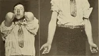 Picture 111 of 481 from Fractures and dislocations, diagnosis and treatment (1915), leaf 168
