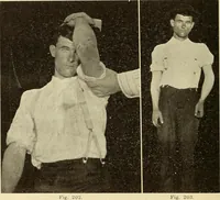 Picture 112 of 481 from Fractures and dislocations, diagnosis and treatment (1915), leaf 169