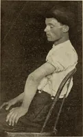 Picture 113 of 481 from Fractures and dislocations, diagnosis and treatment (1915), leaf 170