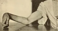 Picture 114 of 481 from Fractures and dislocations, diagnosis and treatment (1915), leaf 172