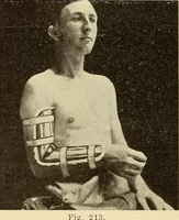An illustration from Fractures and dislocations, diagnosis and treatment (1915)