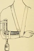 An illustration from Fractures and dislocations, diagnosis and treatment (1915)