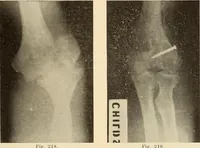 Picture 124 of 481 from Fractures and dislocations, diagnosis and treatment (1915), leaf 180