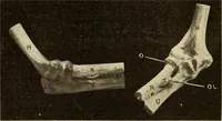 Picture 126 of 481 from Fractures and dislocations, diagnosis and treatment (1915), leaf 185
