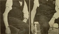 An illustration from Fractures and dislocations, diagnosis and treatment (1915)