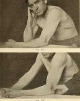 Picture 128 of 481 from Fractures and dislocations, diagnosis and treatment (1915), leaf 190