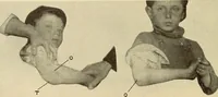 An illustration from Fractures and dislocations, diagnosis and treatment (1915)