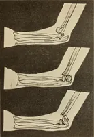 An illustration from Fractures and dislocations, diagnosis and treatment (1915)