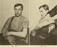Picture 132 of 481 from Fractures and dislocations, diagnosis and treatment (1915), leaf 196