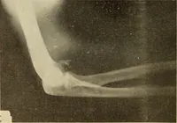 An illustration from Fractures and dislocations, diagnosis and treatment (1915)