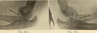 An illustration from Fractures and dislocations, diagnosis and treatment (1915)