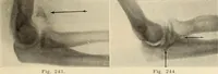 Picture 135 of 481 from Fractures and dislocations, diagnosis and treatment (1915), leaf 198