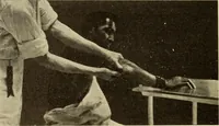 An illustration from Fractures and dislocations, diagnosis and treatment (1915)