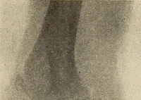 An illustration from Fractures and dislocations, diagnosis and treatment (1915)