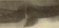 Picture 141 of 481 from Fractures and dislocations, diagnosis and treatment (1915), leaf 218