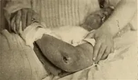 Picture 143 of 481 from Fractures and dislocations, diagnosis and treatment (1915), leaf 220