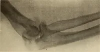 Picture 144 of 481 from Fractures and dislocations, diagnosis and treatment (1915), leaf 224
