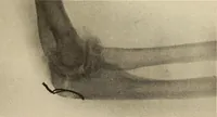 Picture 145 of 481 from Fractures and dislocations, diagnosis and treatment (1915), leaf 224