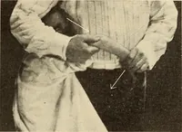 An illustration from Fractures and dislocations, diagnosis and treatment (1915)