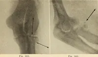 Picture 147 of 481 from Fractures and dislocations, diagnosis and treatment (1915), leaf 228