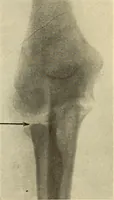 Picture 148 of 481 from Fractures and dislocations, diagnosis and treatment (1915), leaf 229