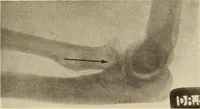 Picture 149 of 481 from Fractures and dislocations, diagnosis and treatment (1915), leaf 230