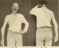 Picture 151 of 481 from Fractures and dislocations, diagnosis and treatment (1915), leaf 232