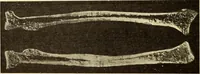 Picture 152 of 481 from Fractures and dislocations, diagnosis and treatment (1915), leaf 235