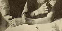Picture 154 of 481 from Fractures and dislocations, diagnosis and treatment (1915), leaf 238