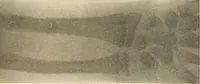 An illustration from Fractures and dislocations, diagnosis and treatment (1915)