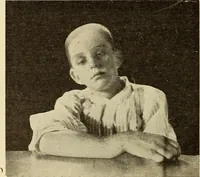 An illustration from Fractures and dislocations, diagnosis and treatment (1915)