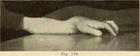 An illustration from Fractures and dislocations, diagnosis and treatment (1915)