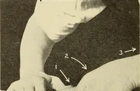 An illustration from Fractures and dislocations, diagnosis and treatment (1915)