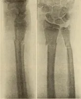Picture 161 of 481 from Fractures and dislocations, diagnosis and treatment (1915), leaf 242