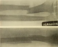 An illustration from Fractures and dislocations, diagnosis and treatment (1915)