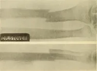 Picture 164 of 481 from Fractures and dislocations, diagnosis and treatment (1915), leaf 245
