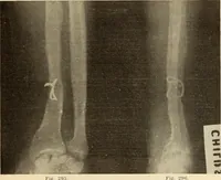 An illustration from Fractures and dislocations, diagnosis and treatment (1915)