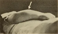 An illustration from Fractures and dislocations, diagnosis and treatment (1915)