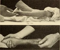 Picture 168 of 481 from Fractures and dislocations, diagnosis and treatment (1915), leaf 248
