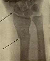 Picture 169 of 481 from Fractures and dislocations, diagnosis and treatment (1915), leaf 248