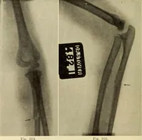 Picture 170 of 481 from Fractures and dislocations, diagnosis and treatment (1915), leaf 249