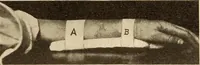 Picture 172 of 481 from Fractures and dislocations, diagnosis and treatment (1915), leaf 254